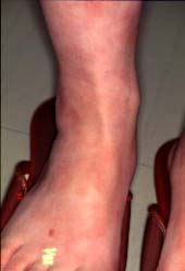 pieda dorso-1 monato