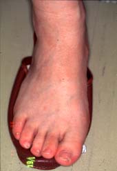 pieda dorso-3 monatoj