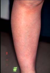 antau~a malsupra kururo-3 monatoj