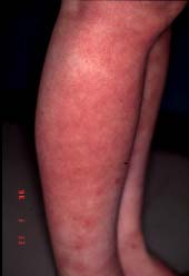 flanka malsupra kururo-unue