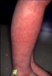 flanka malsupra kururo-1 monato