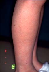 flanka malsupra kururo-3 monatoj