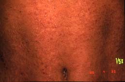 abdomeno-1 jaro