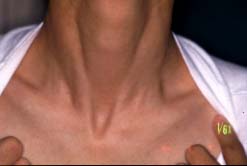 neck-15 weeks later