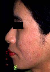 left face -2 weeks later