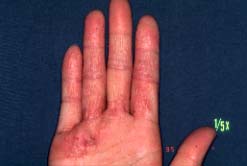 fingers-16 months later
