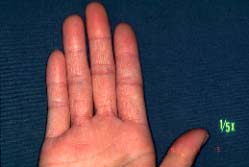 fingers-18 months later