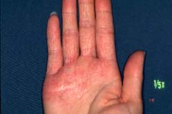 fingers-2 years later