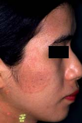 right face-2 weeks later