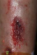 right lower leg-at first coming