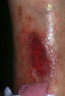 right lower leg-one month later