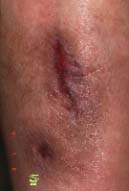 right lower leg-eight months later