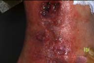 right ankle-one month later