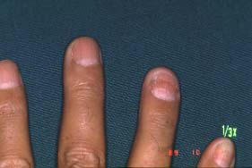 nail-two years later